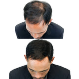 Minoxidil al 5% con pulverizador